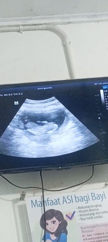 Usia 14 w 1d kata bidan blm kelhtan jk nya insya allah bln dpn kata nya udh klhtan