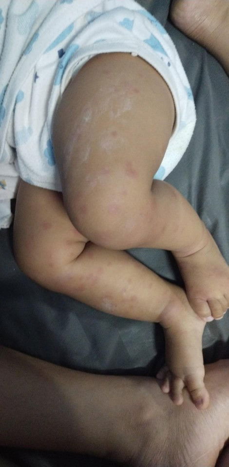 แบบนี้ผื่นอะไรค่ะ