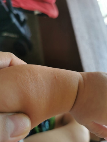 Mga mi anu kaya tong nsa balat ni baby? Sa hiya ang braso meron po sya nyan.