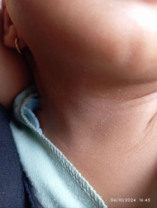 Leher anak putih berair