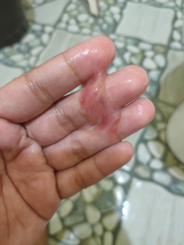 Mucus Plug