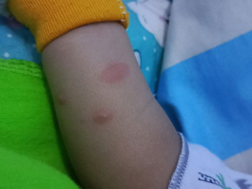 Bun tangan anak aku kaya gini, kecolongan gak tau digigit serangga atau nyamuk udah 4 hari gk hilang