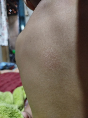Bun mau tanya.. Ini kita kira kena apa ya.. Di punggung anak ku muncul kyk gitu.. ? Udah lama sih