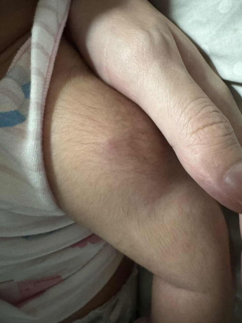 ตุ่มแข็งเป็นไตที่ต้นแขน