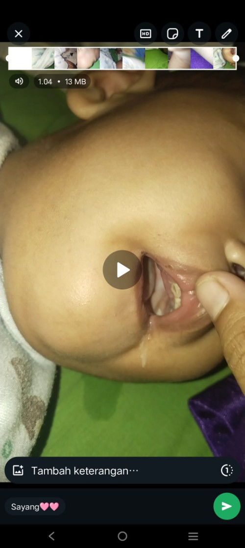 Gusi bengkak tapi tidak lagi tumgi