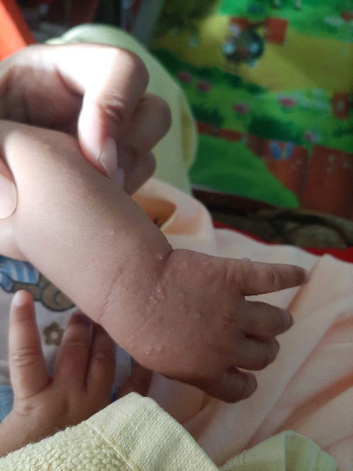 Bintik2 pada tangan bayi