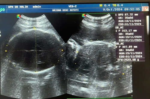 Hasil USG 35 Minggu tapi di aplikasi sudah masuk 36 Minggu 3 hari