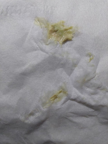 Bun, aq hamil 23minggu lebih ada yg keputihan seperti ini? Apa perlu ke dokter ya?