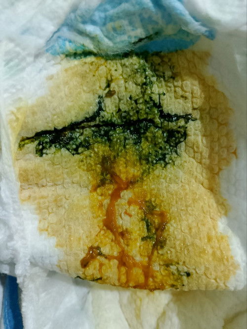 Hello mommies, normal lng ba to? 1st Penta vac kmi kanina nilagnat pero bumaba na. 3rd 💩 today, 4m