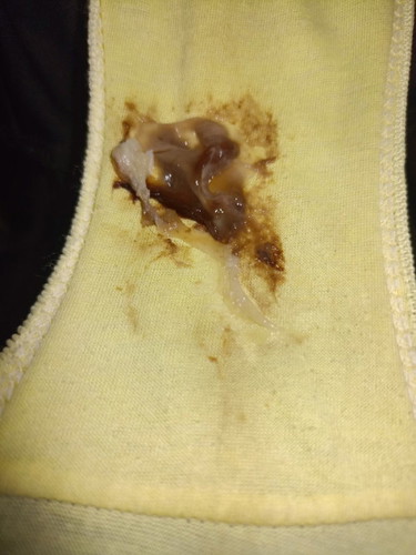 Mucus plug