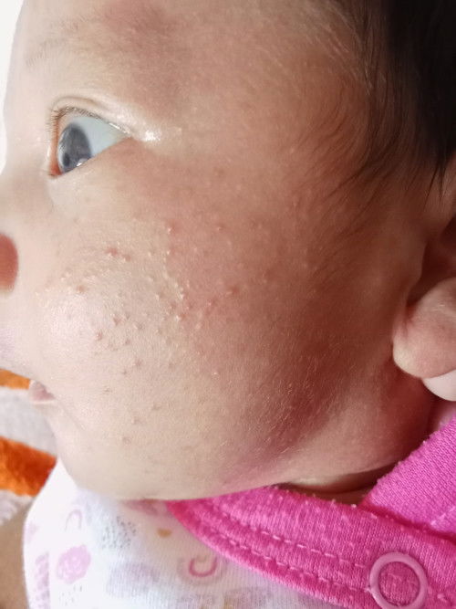 ลูกเป็นผื่น