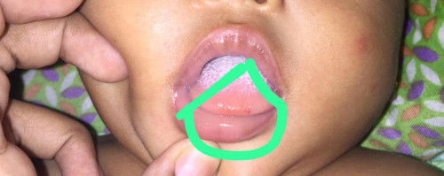 Bintik merah dilidah