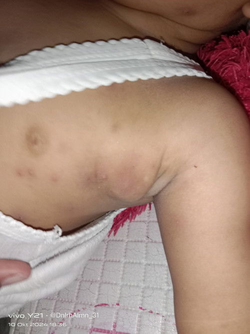 Benjolan pada tubuh bayi 1th