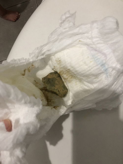 น้องถ่ายไม่ออก