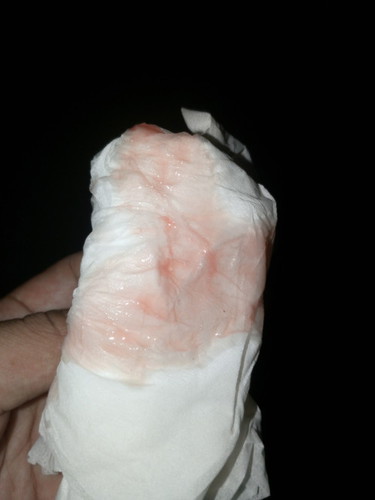 มีมูกเลือดออกแต่ไม่มีอาการเจ็บท้อง