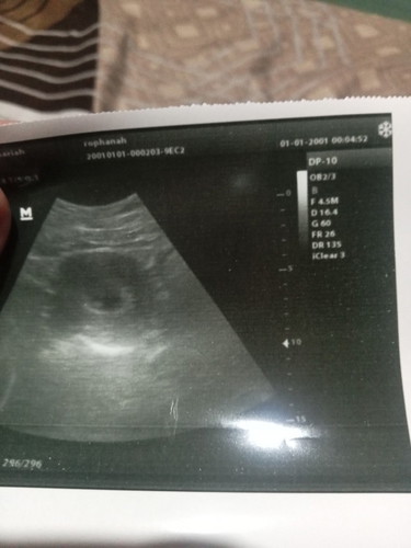 Kandungan usia 8w4d