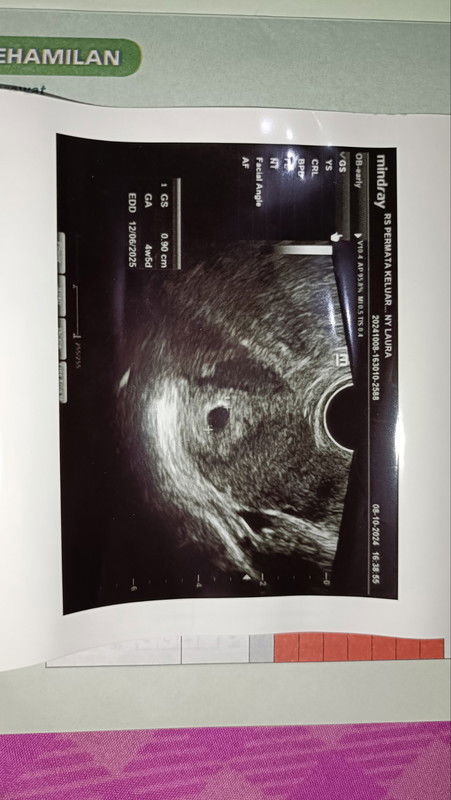 USG beda usia kehamilan dengan hpht
