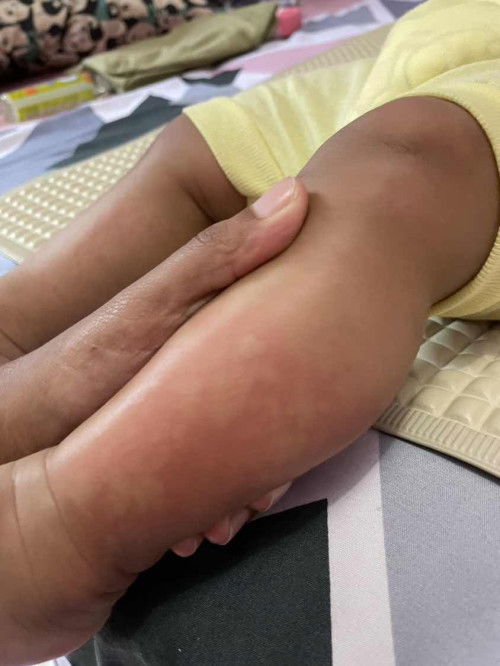 Bayi terkena biduran/kabalan