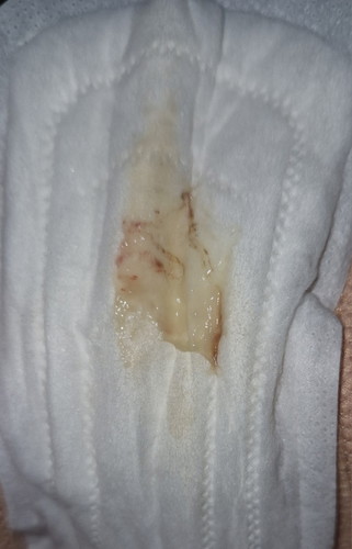 Discharge during Early Pregnancy