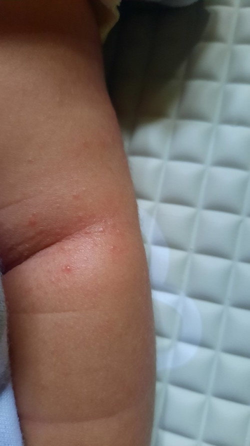 Bintik merah pada bayi