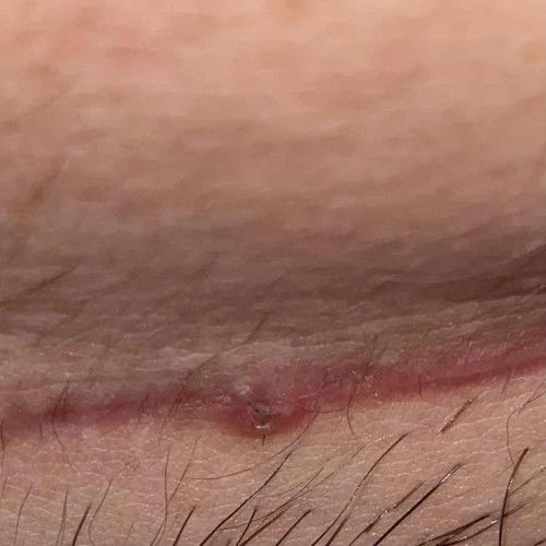 มีใครเคยเป็นมั้ยคะ แบบนี้ปกติของผ่าคลอดมั้ยคะ