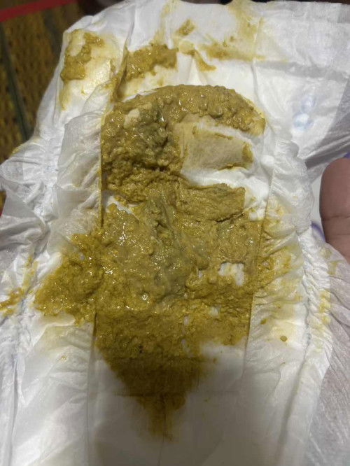 ข้อสอบถามแม่ๆๆหน่อยค่ะ น้องทานนมสำหรับเด็กแพ้นมวัว บวกกับทานนมแม่ถ่ายแบบบนี้ปกติไหมค่ะ