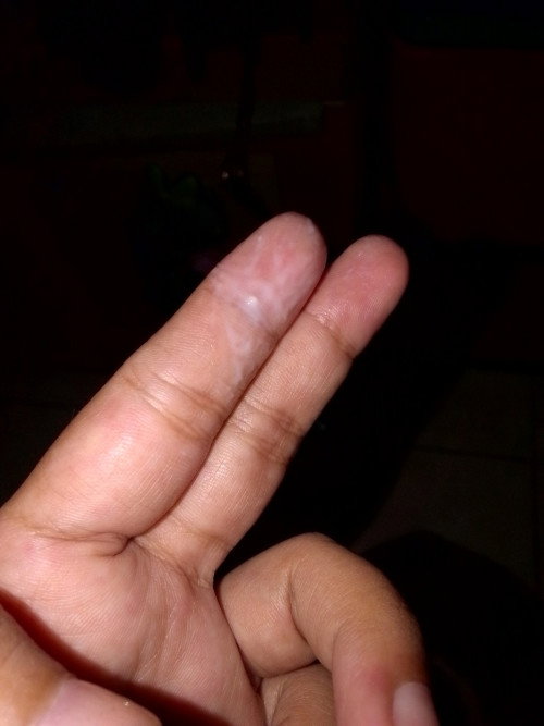 Keputihan+gatal