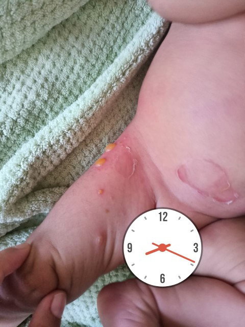 Keluar benjolan seperti nanah