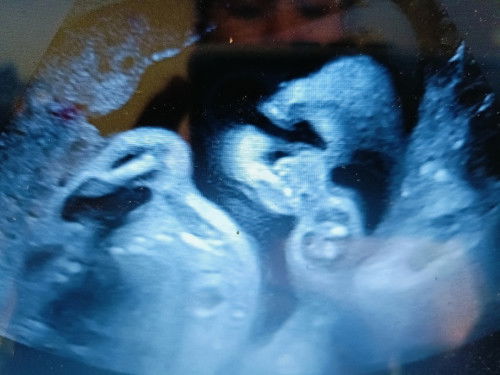 แม่ๆช่วยดูภาพแล้วแม่ๆคิดว่าน้องเป็นดาวซินโดมไหมค่ะ