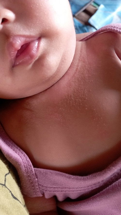 Mohon tanya ini ruam apa yah bun