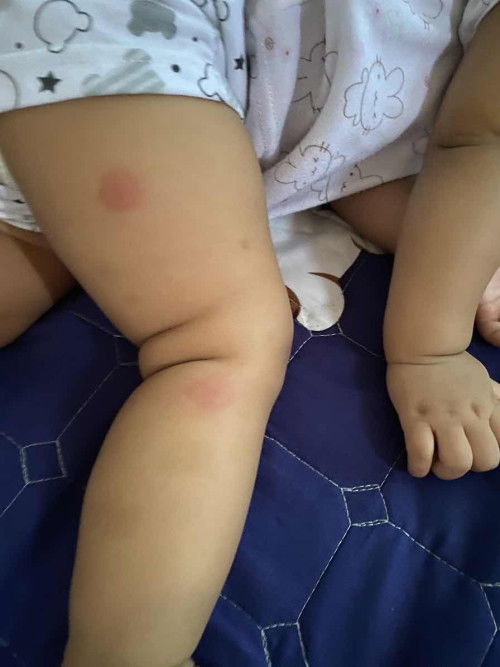 ขอวิธีรักษารอยดำจากตุ่มยุงกัดหน่อยค่ะ