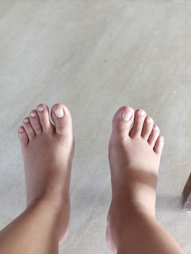 เท้าบวม...