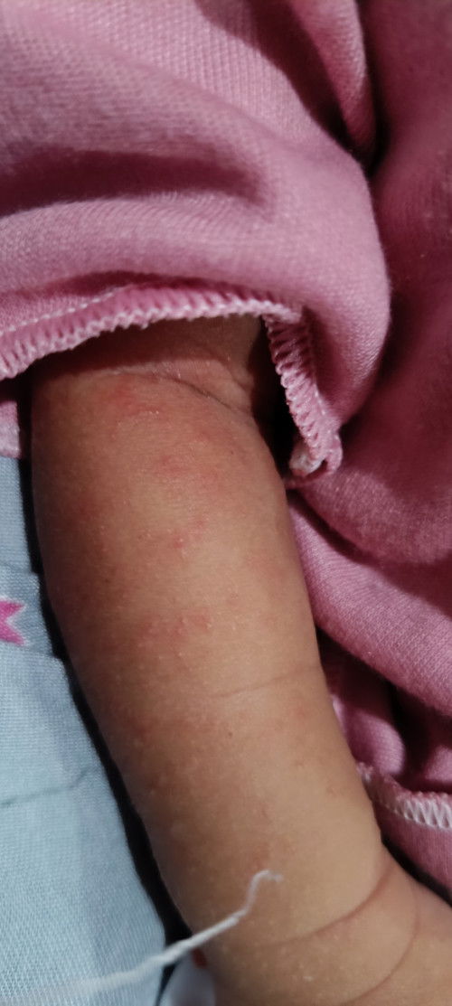 Bun bintik" Merah kayak gini kenapa ya