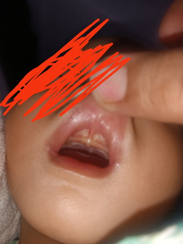 Lip tie or normal
