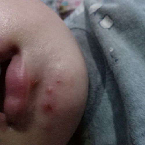 Bintik bintik merah bernanah