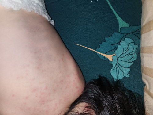 Saya mau tanya bun, di belakang bagian punggung anak saya pd muncul bintik" merah.. Itu knp ya kira"