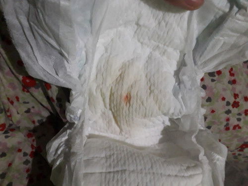 Bercak merah di diapers bayi 2 bulan