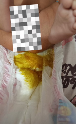 Hi po mga mommies! Normal po ba ito nag change milk po si baby, Allergiv po kaya sya?