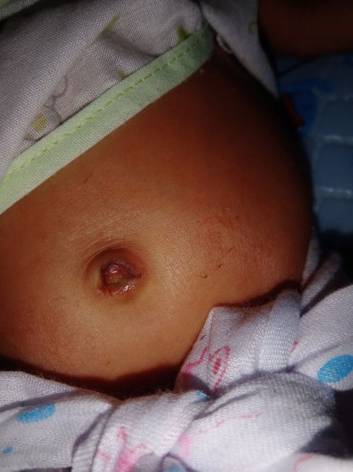 สะดือหลุด