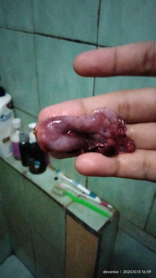 Apakah ini bentuk janin yang keguguran? Soalnya saya ngerasa nyeri perut yang hebat