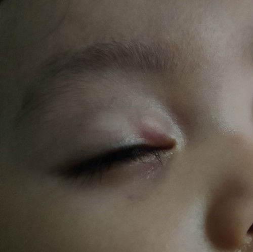 ano po kaya itong bukol sa may talukap ng  mata ni baby ko 11 months lng po sya?