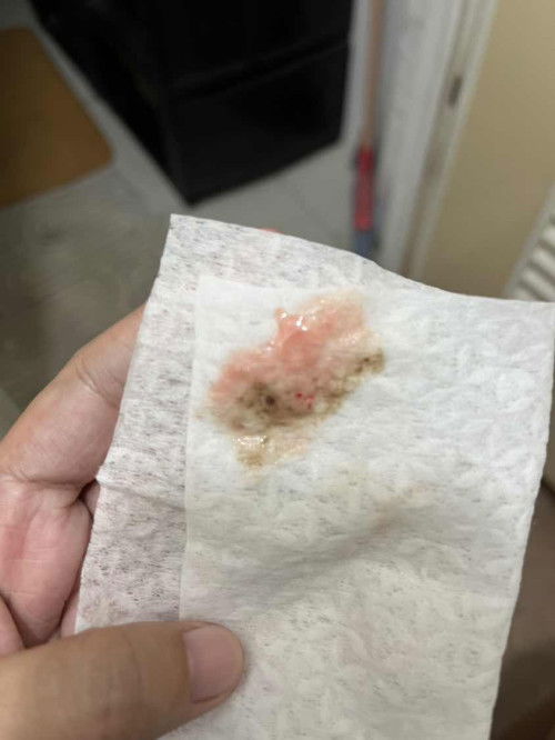 MUCUS PLUG DISCHARGES