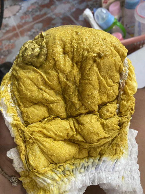 น้องถ่ายเป็นมูกนิดๆ