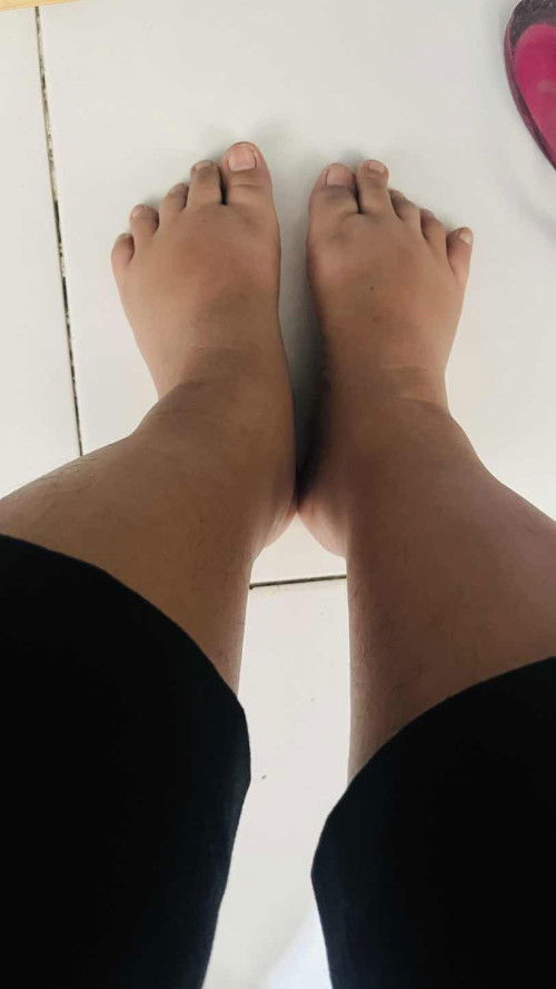 Kaki bengkak ini apa wajar?