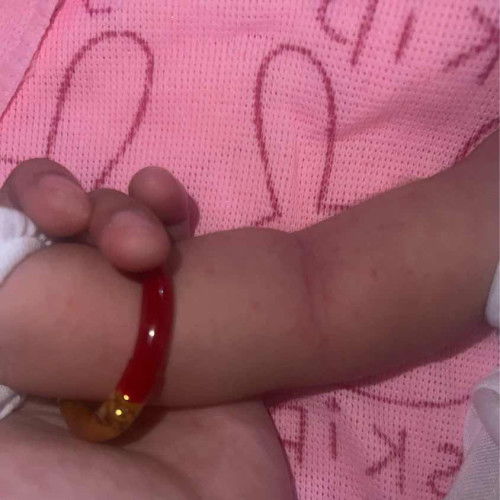 Pantal na parang red pimple sa body parts