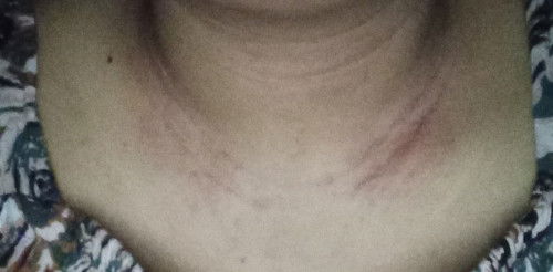 Muncul ruam merah panas dan gatal di leher usia kehamilan 21week