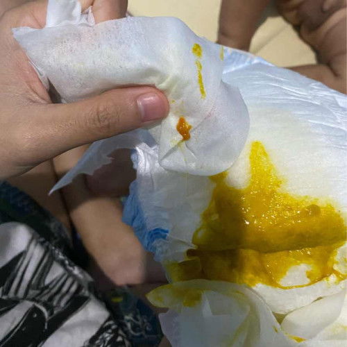 Poop bayi seperti ada darahnya