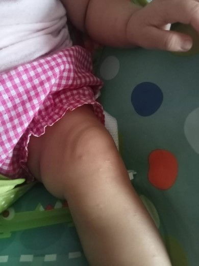 Bun , Udah hampir 1 bulan ni , Di badan anak ku ada bintil2 kecil Bun , di tangan dan di kaki juga