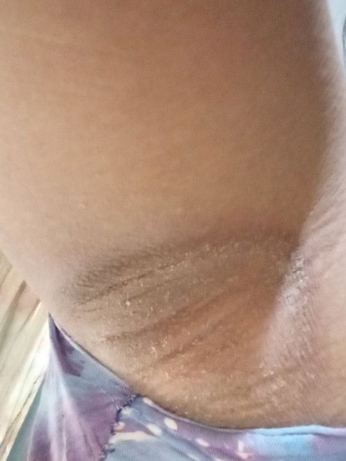 Hamil 5 bulan ketiak hitam dan mengelupas