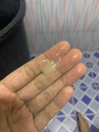 37สัปดาห์+3 ปกติคลอดก่อนกำหนด